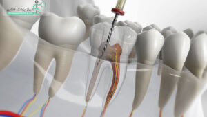 10 نکته که بعد از عصب کشی دندان باید رعایت کنیم